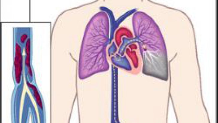 Akciğer Embolisi Nedir?