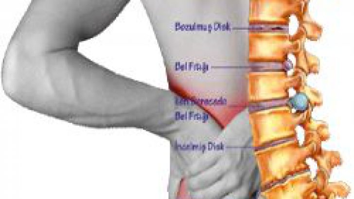 Ne Gibi Zorlamalar Fıtığa Yol Açabilir?